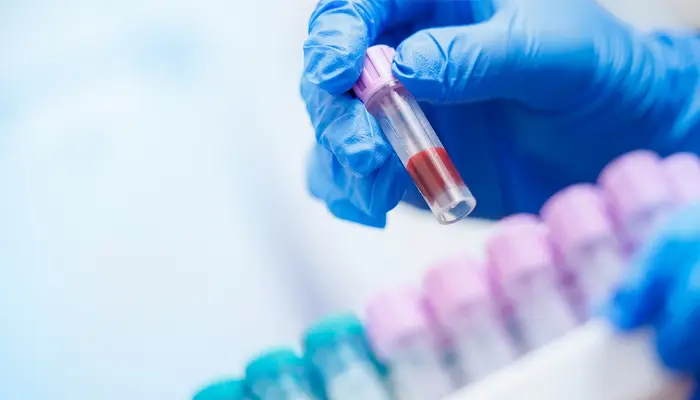 Xét nghiệm đường huyết lúc đói dùng để đo nồng độ glucose trong máu sau khi nhịn ăn 