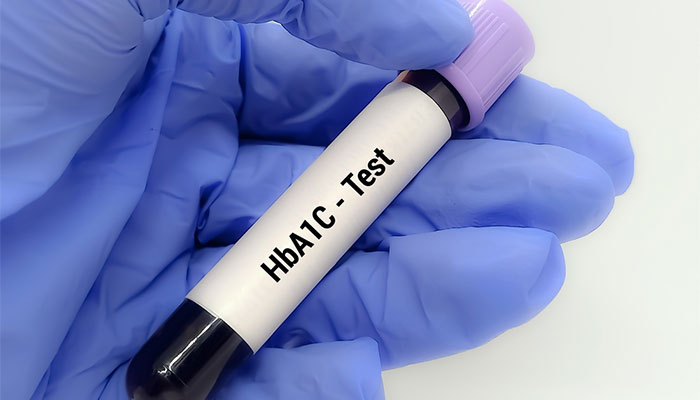 Xét nghiệm HbA1c giúp phát hiện bệnh tiểu đường