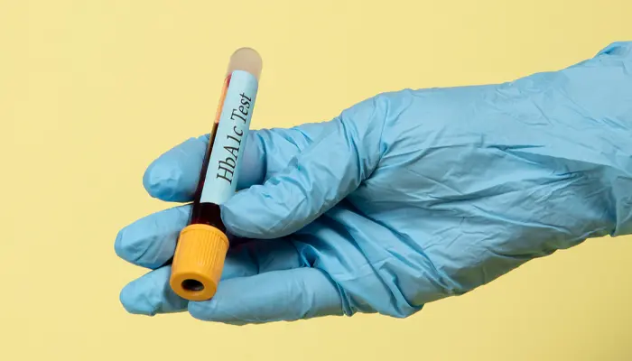 Xét nghiệm HbA1c là xét nghiệm máu giúp chẩn đoán bệnh tiểu đường