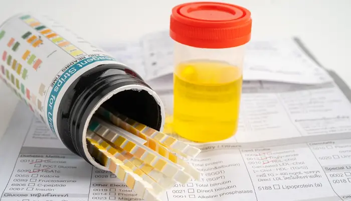 Xét nghiệm nước tiểu có biết bị tiểu đường không? Chỉ giúp phát hiện dấu hiệu nghi ngờ, chưa đủ để chẩn đoán