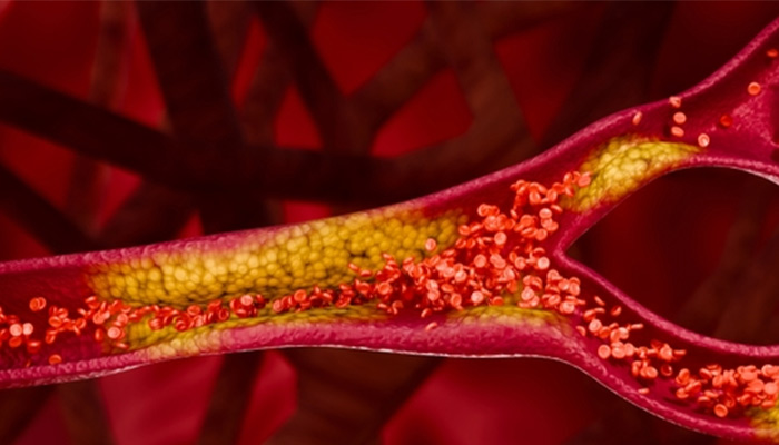 Xơ vữa động mạch do đái tháo đường kèm huyết áp cao gây ra