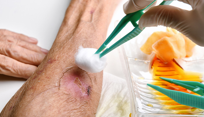 Rửa sạch vết thương