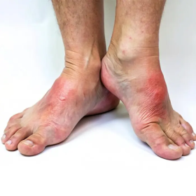 Bàn chân Charcot: Biến chứng thần kinh ở người tiểu đường
