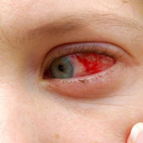  Bệnh võng mạc tiểu đường: Nguyên nhân, triệu chứng và cách phòng ngừa