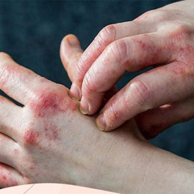 Bị tiểu đường bao lâu thì biến chứng và cách phòng ngừa hiệu quả