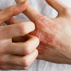 Biến chứng tiểu đường ở da và nguyên nhân hình thành