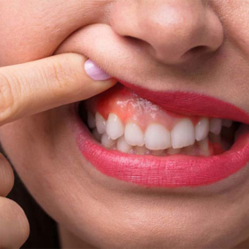 Biến chứng tiểu đường ở răng: Dấu hiệu nhận biết và cách phòng ngừa 