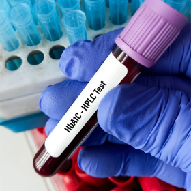 Chỉ số HbA1c bao nhiêu là bị tiểu đường? Cách cải thiện hiệu quả