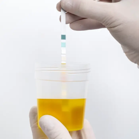 Glucose trong nước tiểu 500 phản ánh mức đường huyết thế nào?