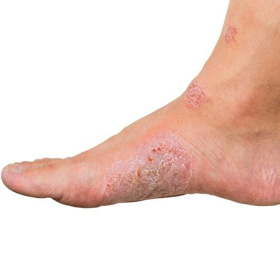 Hậu quả của bệnh tiểu đường: Những biến chứng nguy hiểm cần biết