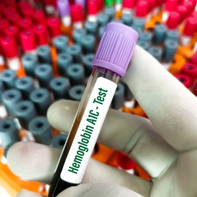 HbA1c tiền tiểu đường là xét nghiệm gì? Chỉ số bao nhiêu? HbA1c tiền tiểu đường là xét nghiệm gì? Chỉ số bao nhiêu?