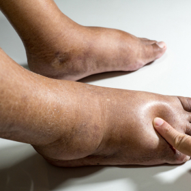 Người bệnh tiểu đường bị phù chân: Nguyên nhân và cách giảm sưng hiệu quả