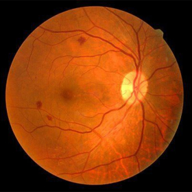 Phù hoàng điểm do tiểu đường: Nguyên nhân và hướng điều trị