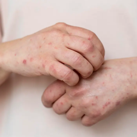 Tác dụng phụ của thuốc tiểu đường và những lưu ý khi sử dụng 