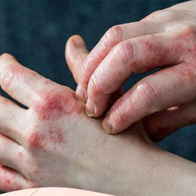 Tại sao bệnh nhân tiểu đường dễ bị nhiễm trùng và cách phòng ngừa?