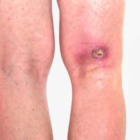 Tại sao bệnh tiểu đường vết thương lâu lành và dễ nhiễm trùng?