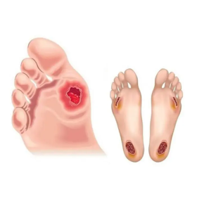 Tại sao tiểu đường gây hoại tử? Nguyên nhân cần biết