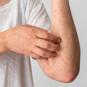 Tiểu đường bị ngứa da do đâu? Làm sao để cải thiện triệu chứng? 