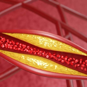 Tổn thương mạch máu do bệnh tiểu đường ảnh hưởng gì cơ thể?